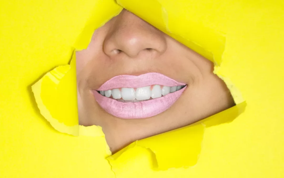 Claves para un blanqueamiento dental en Sevilla