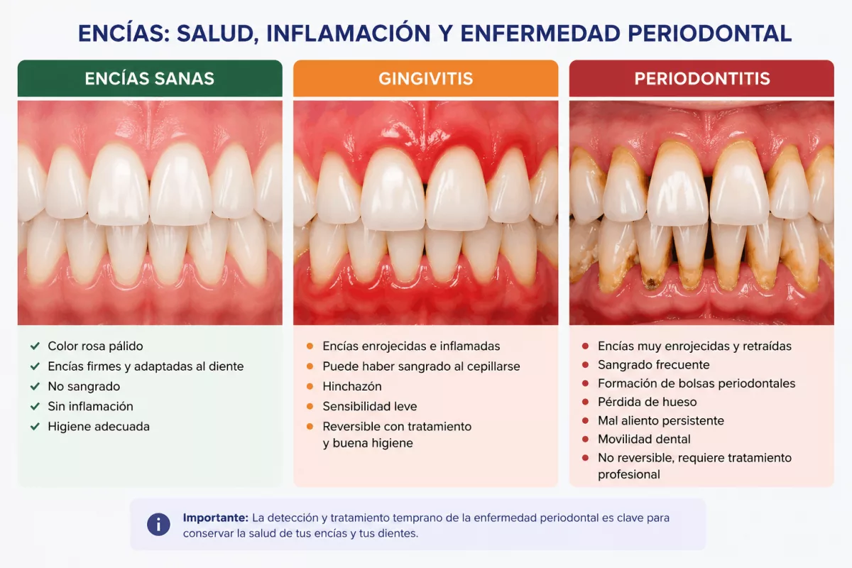 Periodoncia en Sevilla: cuándo el sangrado de encías requiere atención 2 comparativa encias sanas gingivitis periodontitis